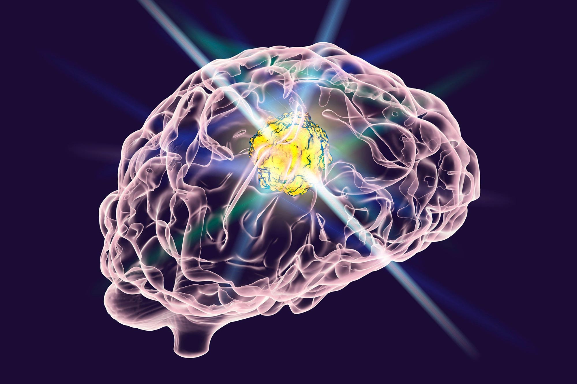 The Journey Of Glioblastoma: Insights Into A Challenging Brain Tumor