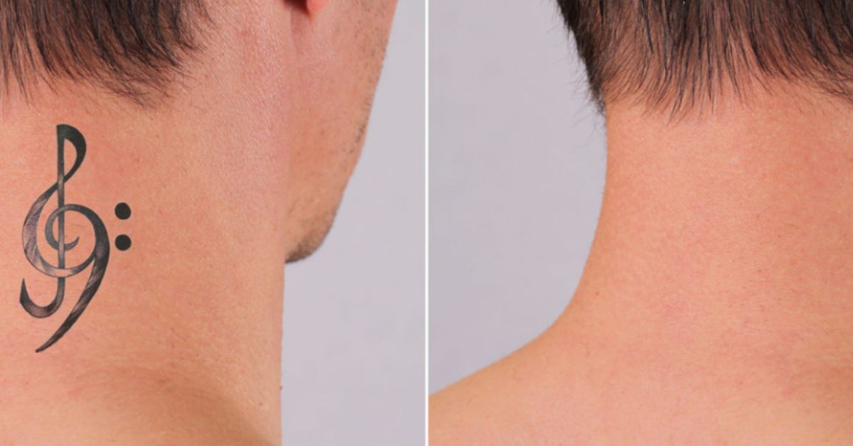 Tattoo Removal